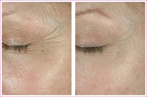 Plexaderm Before and After Pictures