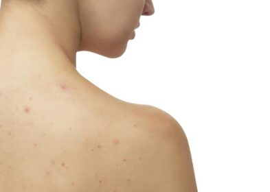 How To Get Rid Of Back Acne : The Ultimate Guide