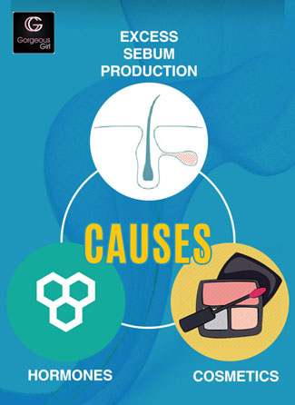 Causes of blackheads and whiteheads