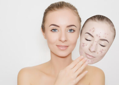 Acne scar removal treatment, Is it Really Good For Your Skin?