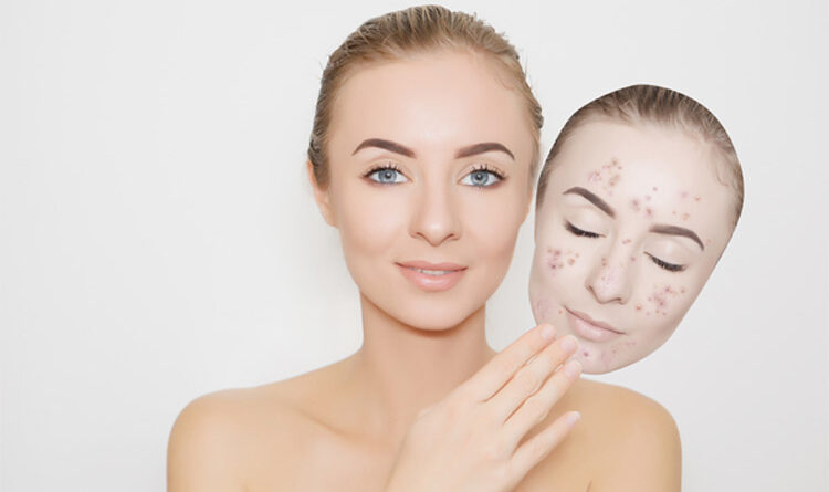 Acne scar removal treatment, Is it Really Good For Your Skin?