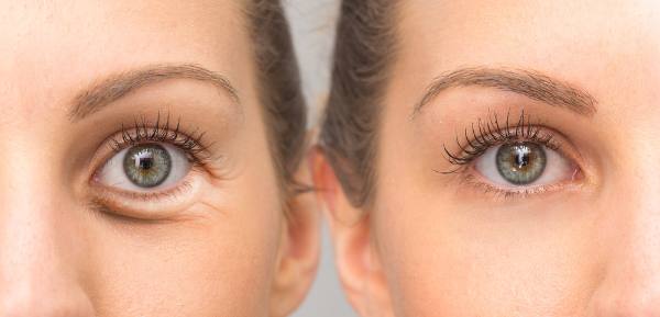 Causes Under Eye Puffiness