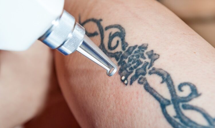 Laser Tattoo Removal Facts You Should Definitely Know About