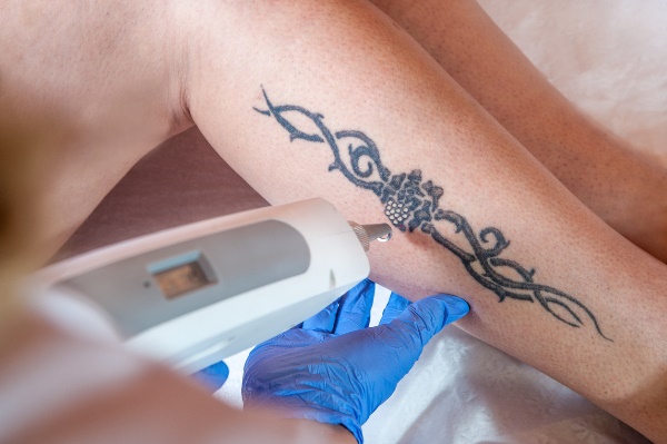 laser tattoo removal effects