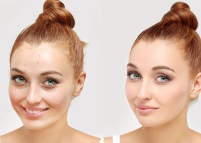 Adult Acne Diet: 7 Foods You Must Eat To Clear Adult Acne In No Time.