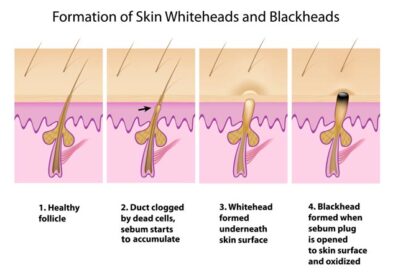 Blackheads Vs Whiteheads – What Exactly Is The Difference?
