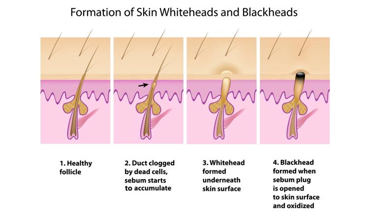 Blackheads Vs Whiteheads – What Exactly Is The Difference?