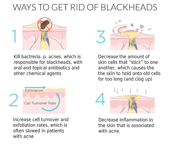 Get rid of blackheads