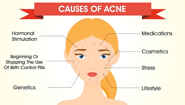 causes-of-acne