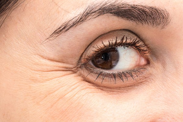 causes of crow’s feet