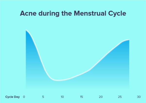causes of hormonal acne