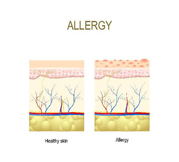 causes of skin allergy
