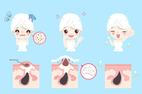 how to get rid of comedones