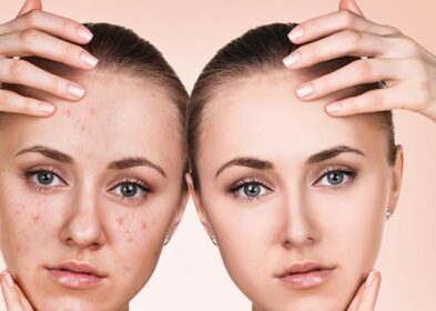 Understanding The Stages Of Acne And Its Treatments