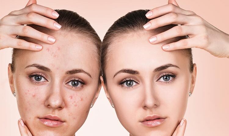 Understanding The Stages Of Acne And Its Treatments