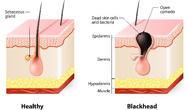 what are blackheads