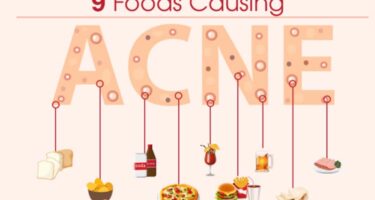 What Foods Cause Acne: Avoid These 9 Foods For Acne Free Skin