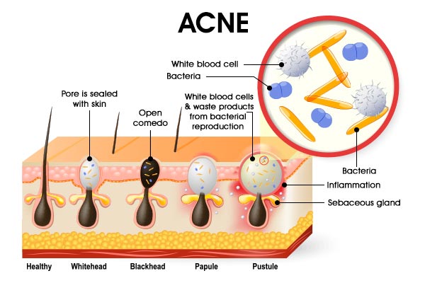 What Is Acne