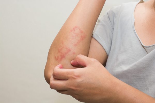 what is dry skin rash