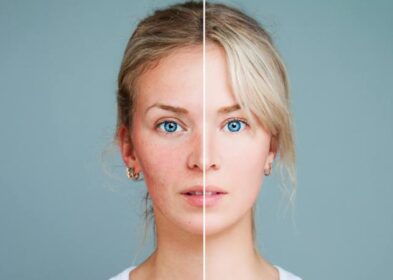 Acne Rosacea: Meaning, Symptoms, Causes, Treatments And Diet To Follow