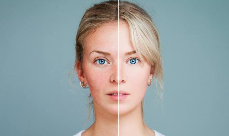 Acne Rosacea: Meaning, Symptoms, Causes, Treatments And Diet To Follow