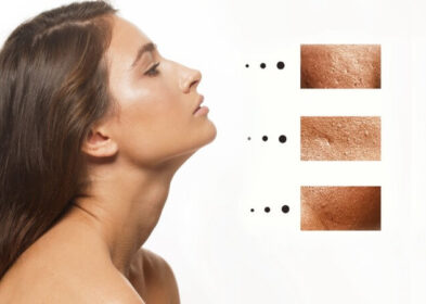 Big Pores On Face: Know Their Causes And Ways To Minimize Them