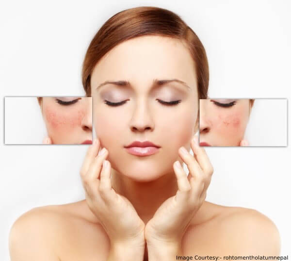 Causes Of Enlarged Pores