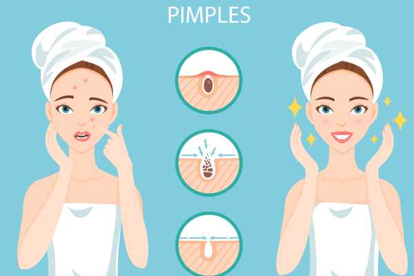 Causes Of Pimple
