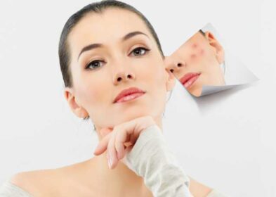 5 Trouble-Free Tricks On How To Get Rid Of A Pimple Overnight