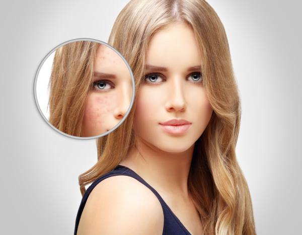 Keloid Acne Scar