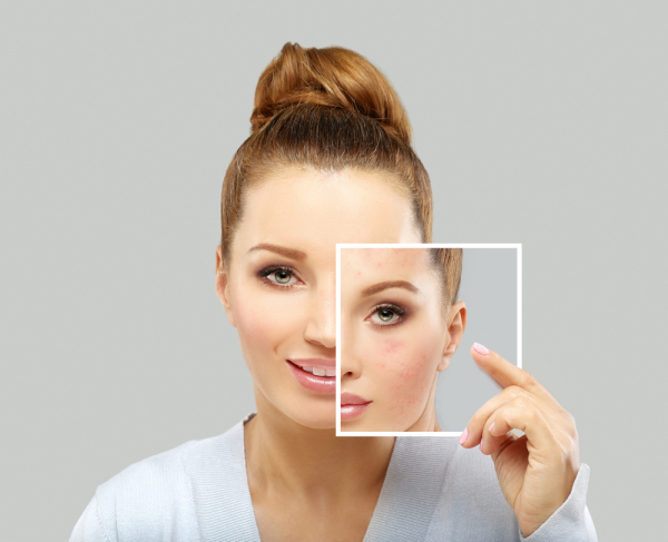 Lemon Water Skin Benefits 