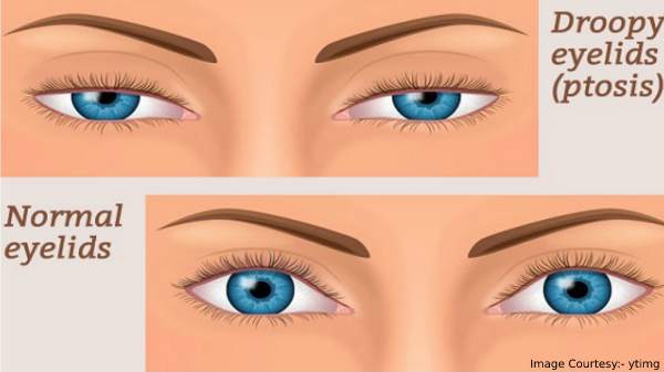 Ways To Treat Sagging Eyelids