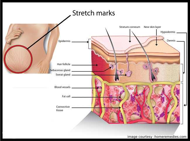 What Are Stretch Marks