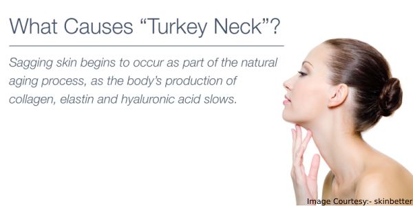 Causes Of Turkey Neck