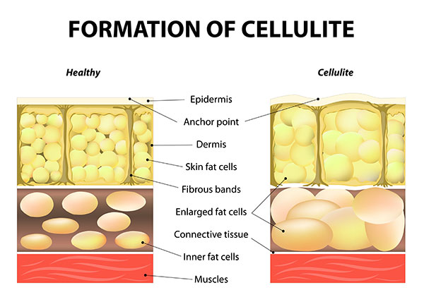 cellulite formation