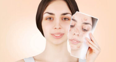 Clear Liquid Pimple – Know the Causes and Treatment for Clear Fluid in Pimple.