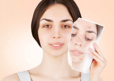 Clear Liquid Pimple – Know the Causes and Treatment for Clear Fluid in Pimple.