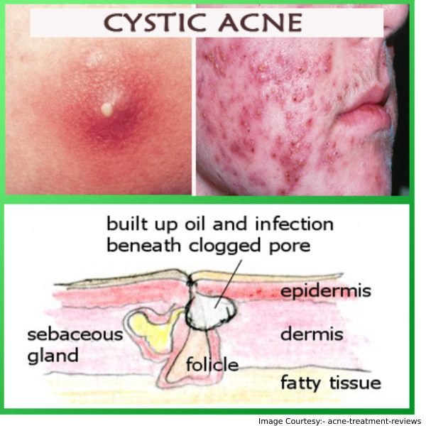 Cystic Acne