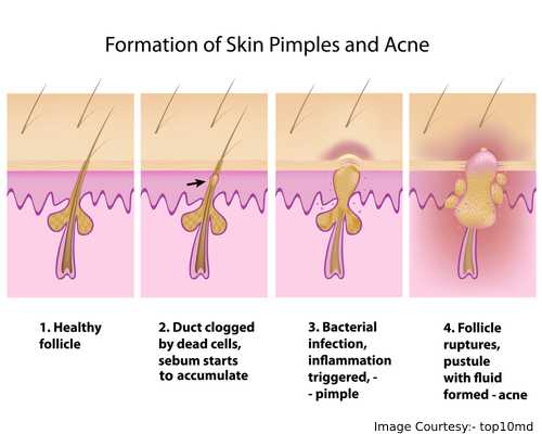 Formation Of a Pimple