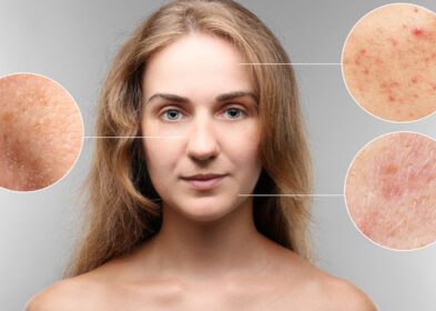 How To Get Rid Of Keratosis Pilaris: Causes, Diet And Treatments