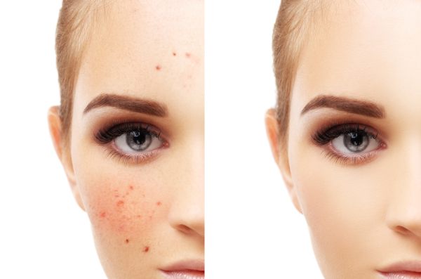 Treatment Of Cystic Acne