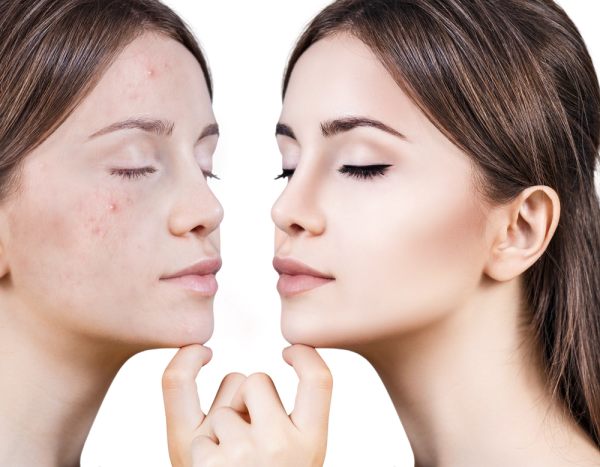 Treatments To Remove Papule