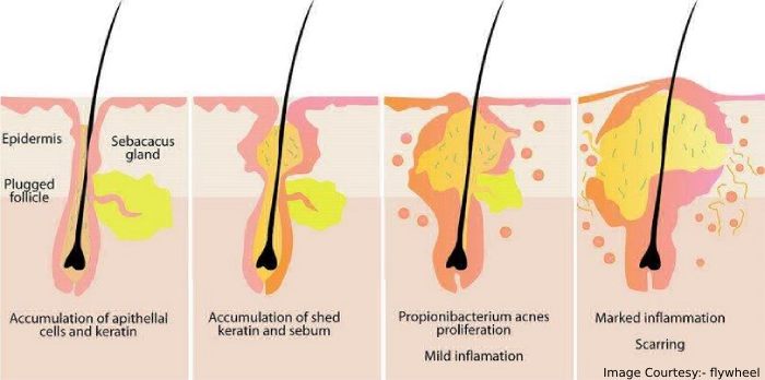 What Is a Cystic Acne