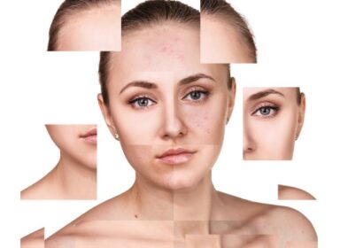 What Is a Papule? Know Its Meaning, Causes And Treatments To Remove