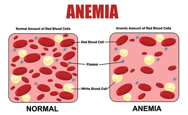 anemia-diagnosis
