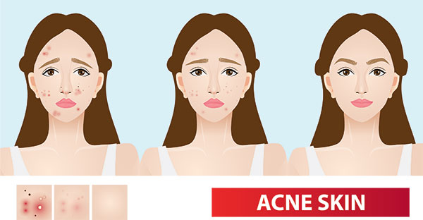 Acne Reduction
