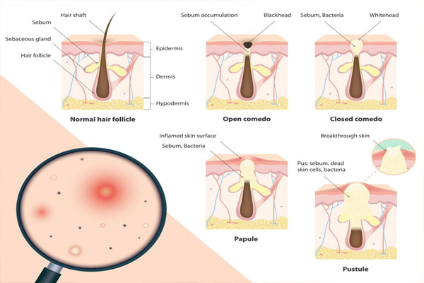 blackheads symptoms