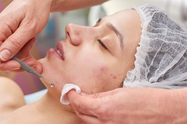 micro-needling treatment