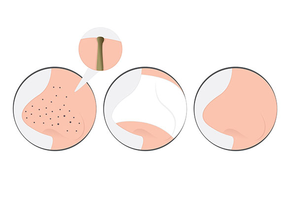 causes of blackheads on nose
