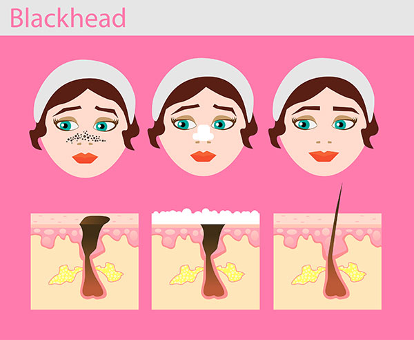 causes of blackheads